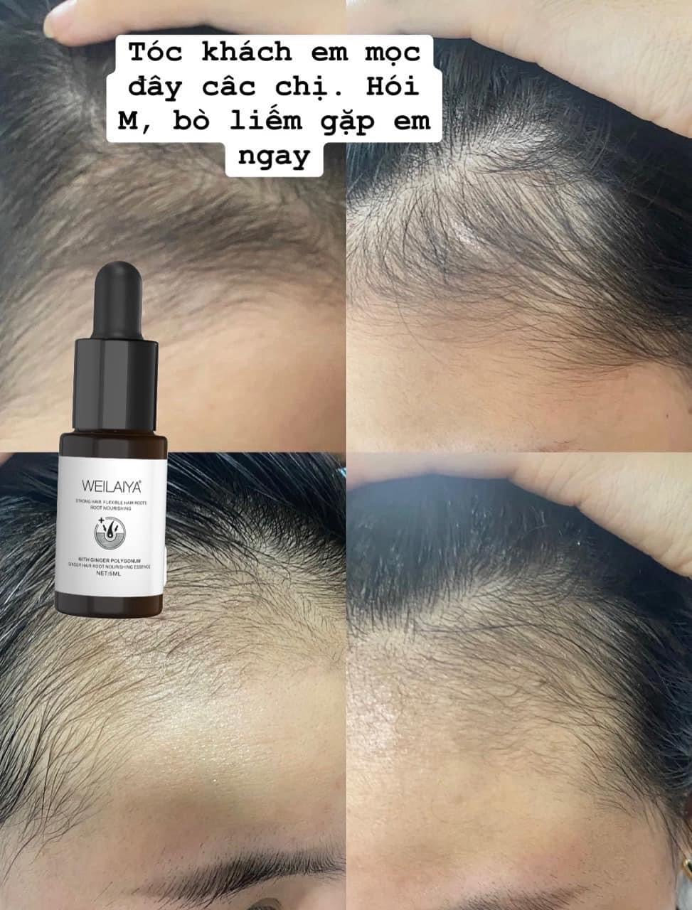 Weilaiya Hair Growth Serum (Huyết Thanh Mọc Tóc)